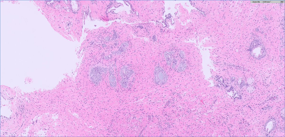 #GUpath prostate laser enucleation for BPH:

worrisome luminal mucin?

nah...just #beautyinb9 basal cell hyperplasia (can occasionally have mucin🚨+nucleoli)