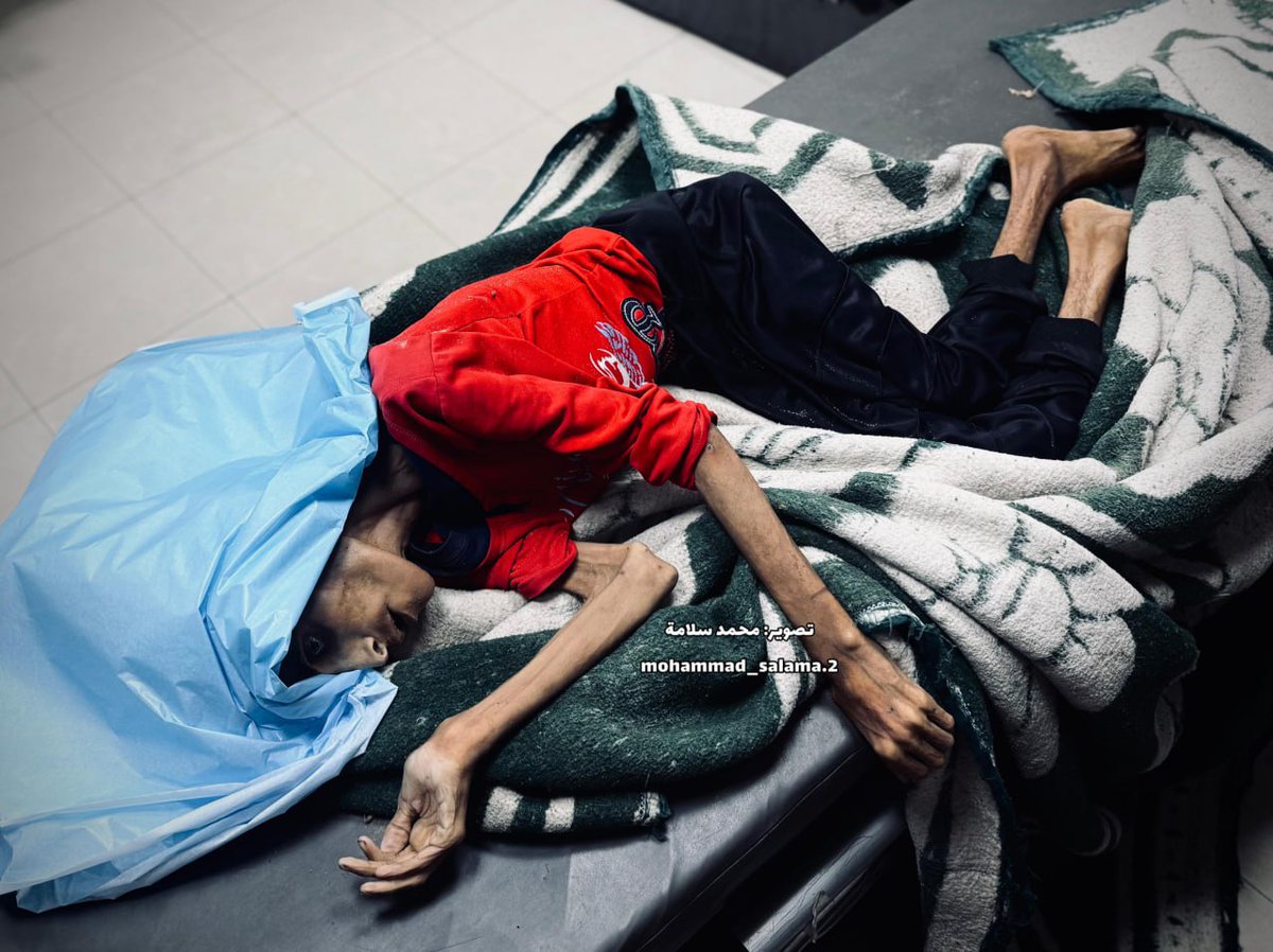 🟥 صور الشهيدة رحيل محمد رصرص، والتي استشهدت جراء سوء التغذية والجفاف في خانيونس، بفعل المجاعة والحصار

#الإجرام_الصهيوني