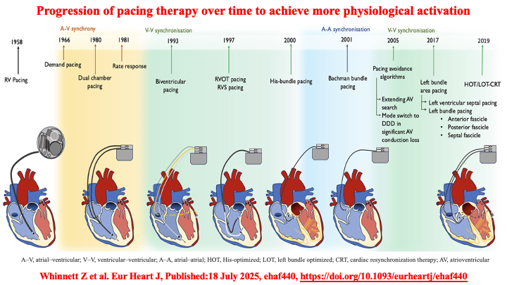 Raviele Antonio (@drraviele) on Twitter photo 📌 Figure illustrating
👉 Progression of #pacing therapy over time to achieve more physiological activation
#EPeeps #CardioTwitter #MedTwitter #LBBP #dontdisthehis <a href="/ZHeart11768530/">The Heart</a> <a href="/drrakeshg1/">Rakesh Gopinath</a> <a href="/ZHeart11768530/">The Heart</a> <a href="/Hisdoc1/">Pugal Vijayaraman</a> <a href="/adribaran/">Adrian Baranchuk MD FACC FRCPC FCCS FSIAC</a> <a href="/Hragy/">Hany Ragy</a> @gopi_gdanda1 <a href="/yolyabreuh/">Yolanda Abreu H.</a> <a href="/JorgeERomeroMD/">Jorge E. Romero, MD, FACC, FHRS</a> 📌 Figure illustrating
👉 Progression of #pacing therapy over time to achieve more physiological activation
#EPeeps #CardioTwitter #MedTwitter #LBBP #dontdisthehis <a href="/ZHeart11768530/">The Heart</a> <a href="/drrakeshg1/">Rakesh Gopinath</a> <a href="/ZHeart11768530/">The Heart</a> <a href="/Hisdoc1/">Pugal Vijayaraman</a> <a href="/adribaran/">Adrian Baranchuk MD FACC FRCPC FCCS FSIAC</a> <a href="/Hragy/">Hany Ragy</a> @gopi_gdanda1 <a href="/yolyabreuh/">Yolanda Abreu H.</a> <a href="/JorgeERomeroMD/">Jorge E. Romero, MD, FACC, FHRS</a>