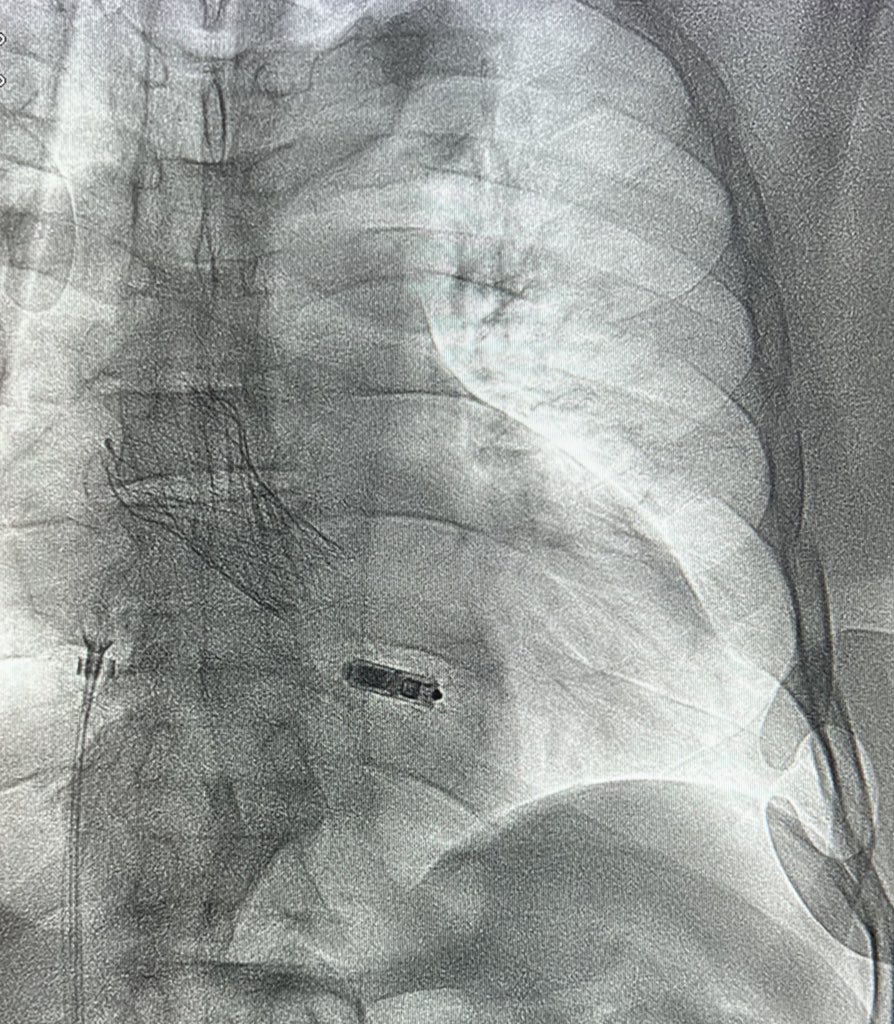 EPWaveDoc's tweet image. 73M with symptomatic AS on dialysis. 
Pre-TAVI PR 220 ms → post-TAVI PR 400 ms + new LBBB. HV 80 ms. #Leadless #pacemaker implanted with Francesco Montereggi at CHU de #Martinique. #Cardiology #Epeeps