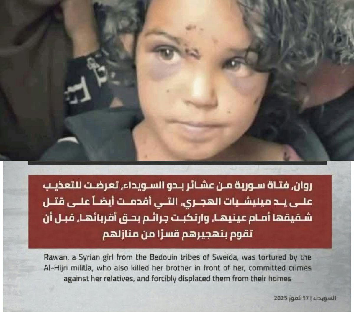 ⛔️ ميليشيا الهجري تعذّب طفلة وتقتل شقيقها أمام عينيها 

#زمان_الوصل
وثّقت عدة شهادات ولقاءات مصوّرة جريمة جديدة ارتكبتها ميليشيا الهجري الطائفية في محافظة السويداء، طالت الطفلة السورية "روان" المنحدرة من عشائر البدو. 

تعرضت روان لتعذيب وحشي على يد عناصر الميليشيا، التي أقدمت