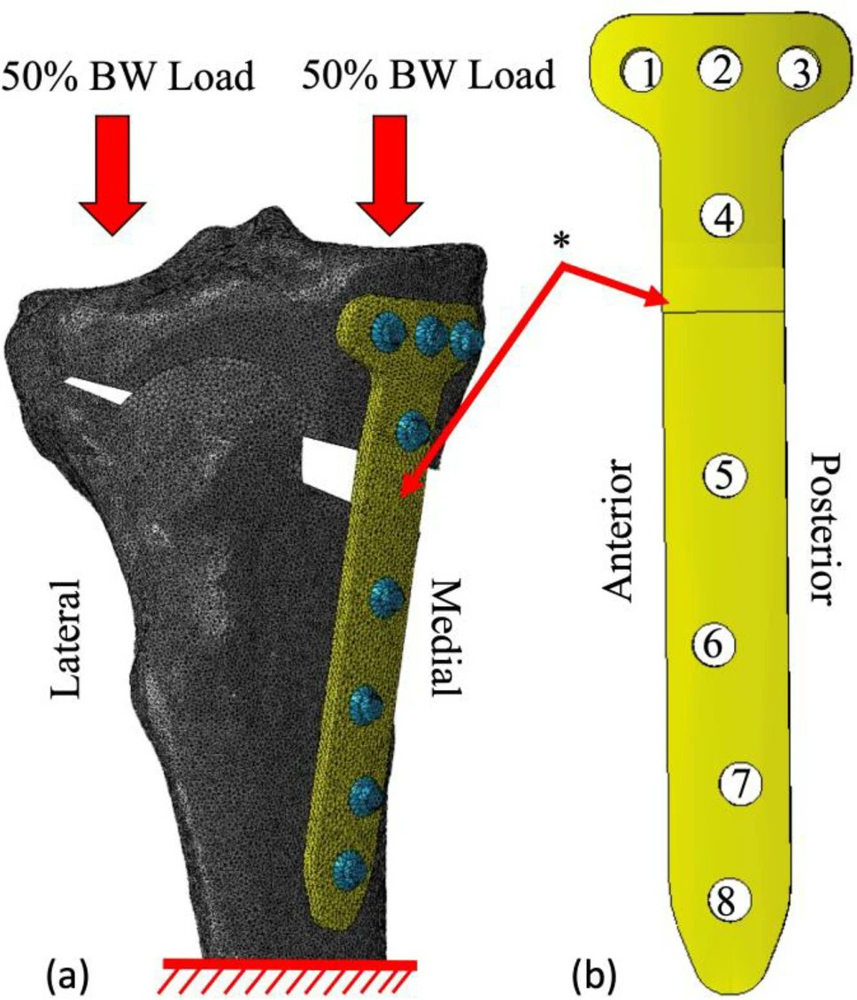 ABMEjournal's tweet image. Surgeons aiming to relieve knee pain from arthritis often turn to realignment procedures that shift pressure away from damaged areas.
Researchers compared two finite element modeling techniques used in planning medial opening wedge high tibial osteotomy, a surgery designed to…