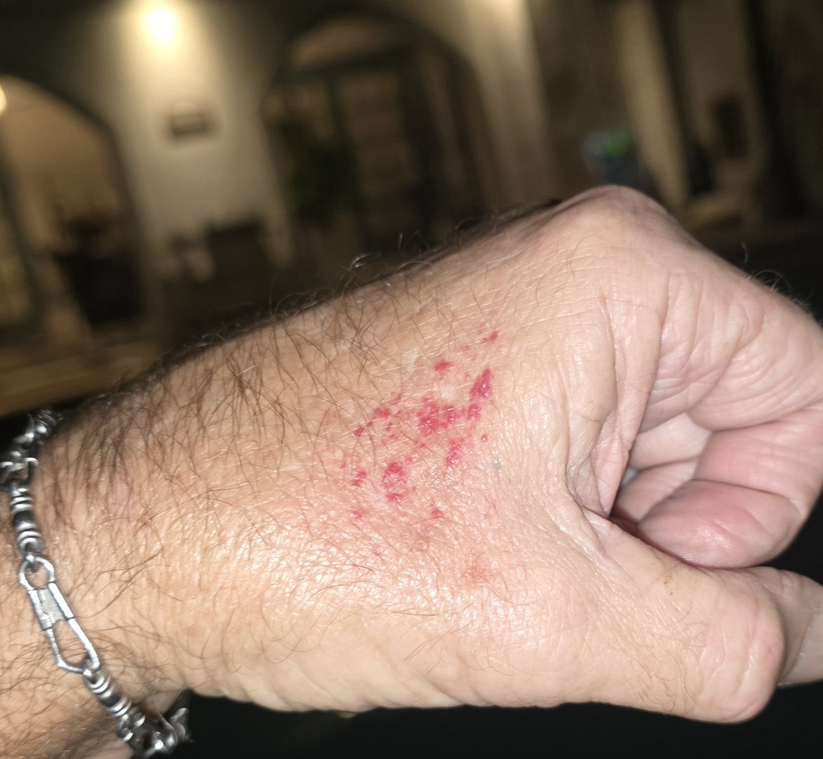 Demonitizr's tweet image. This is a crazy reaction to a mosquito bite. I have never seen this. I have never had West Nile Virus either...😬