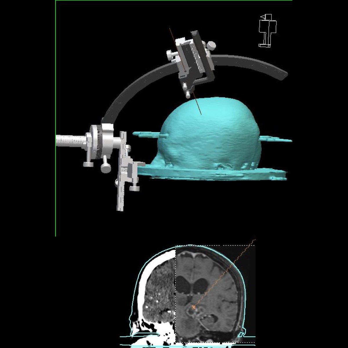 DROSCARZORRO's tweet image. La estereotaxia sigue siendo una herramienta útil,
en biopsias por estereotaxia de localización compleja como pineal, tallo cerebral tálamo. Es una técnica eficiente con baja morbilidad y con diagnóstico histopatológicos que orientan al tratamiento definitivo de los pacientes.