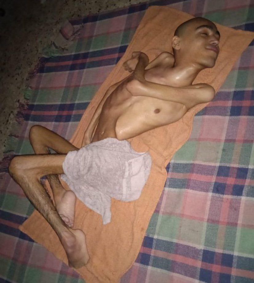 rida_ehab's tweet image. A young man's body in Gaza collapsed completely, reduced to a skeleton due to starvation. He was paralyzed not by a bullet, but by hunger that shattered his bones and robbed him of his life while he was still alive.
@ARMY4Palestine
@aechoire @DirectAidGaza