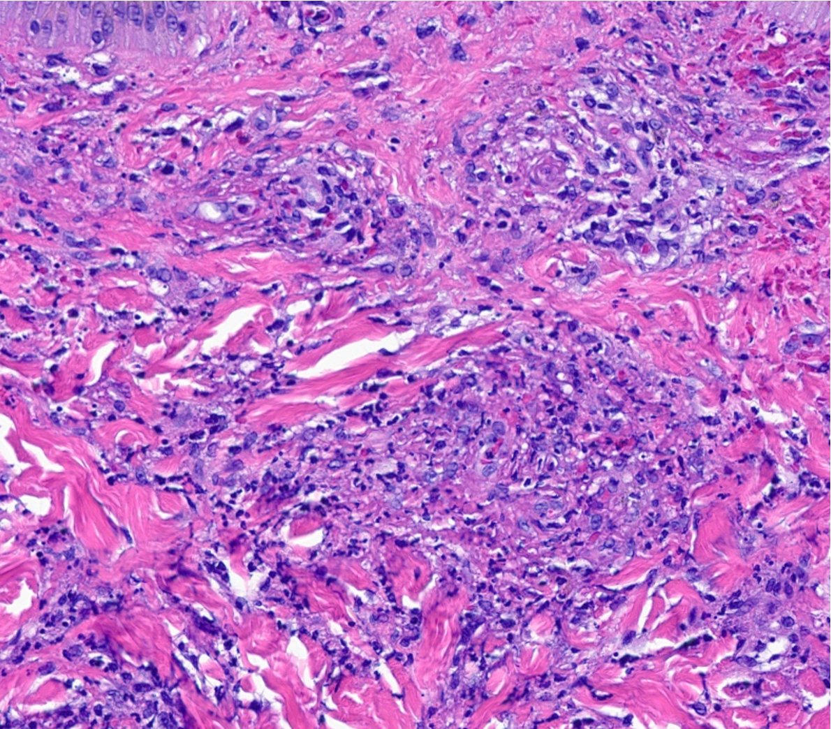 👑 Leukocytoclastic vasculitis — one to rule them all, and in the vessels bind them 💥🧙‍♂️ #pathology #pathologists #pathTwitter #dermpath #dermatology #dermtwitter
