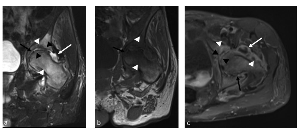 Septic Arthritis: Current Concepts
DOI doi.org/10.1055/s-0045….

This review article focuses on current concepts in the diagnosis and imaging of septic arthritis, a condition associated with significant morbidity and mortality. Prompt diagnosis is critical to minimize