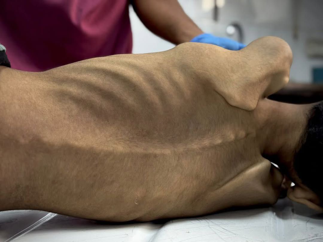 doamuslims's tweet image. 12-year-old Abdeljawad Al-Ghalban died this morning in #Gaza due to severe malnutrition amid ongoing Israeli war of starvation.