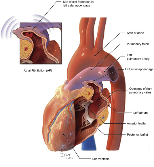 NephroP's tweet image. New left atrial "mass" after cardiac surgery? 
Think Inversion of the Left Atrial Appendage‼️
#POCUS #echofirst #FOAMed 
(Most cases resolve spontaneously)
