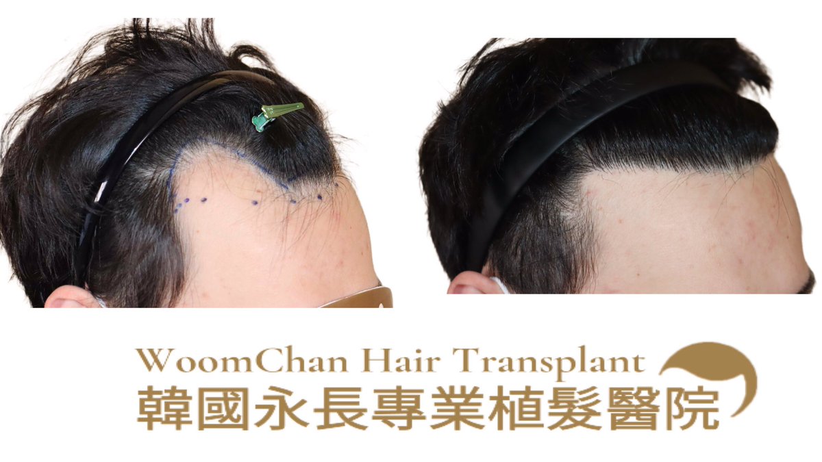 Woomchan88's tweet photo. 3000根頭髮效果，還可以嗎😌
微信 :woomchan 
line👉Woomchan 88
whatsapp: +821097895827
https://t.co/CHr7FRHGVl
 #韓國免剃髮植髮 #永長植髮 #woomchan永長植髮 #韩国植发医院 #韩国植髮費用 #hairtransplantsurgery #韓國免剃发植发 #FUE免剃发植 #韓國植髮 #台灣植髮 https://t.co/ssMRTofK40