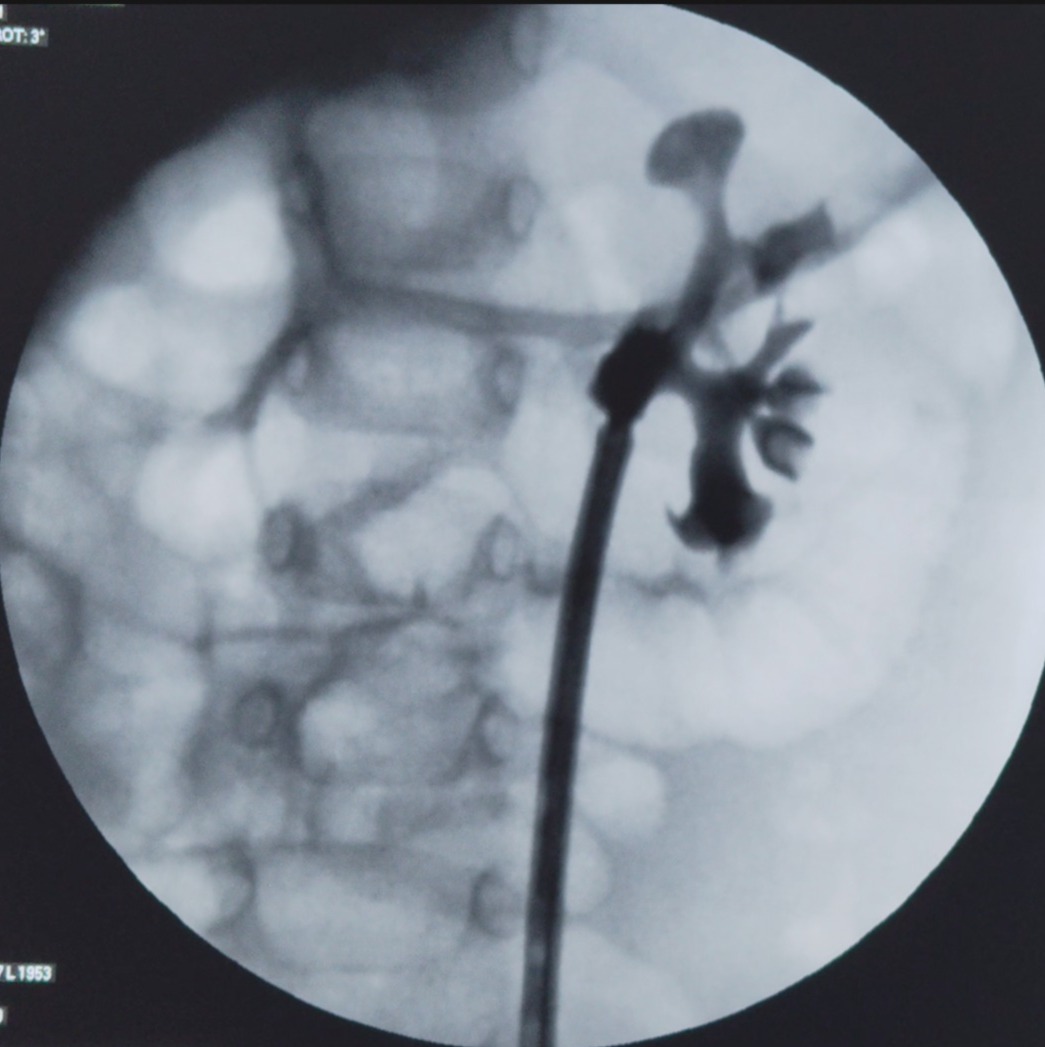 FANS RIRS with small length 30 cm FANS sheath 

A 14-month-old male with bilateral large-volume cystine stones.

Right kidney: Mini-PCNL performed successfully.

Left kidney: FANS-RIRS done using a 6.3 Fr flexible scope and 30 cm access sheath.
Complete clearance achieved in 48