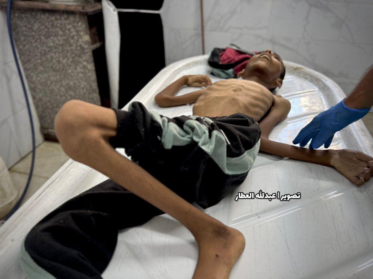 abdallahatar's tweet image. الطفل عبد الجواد الغلبان عمره 14 سنة توفي بسبب سوء تغذية حاد .