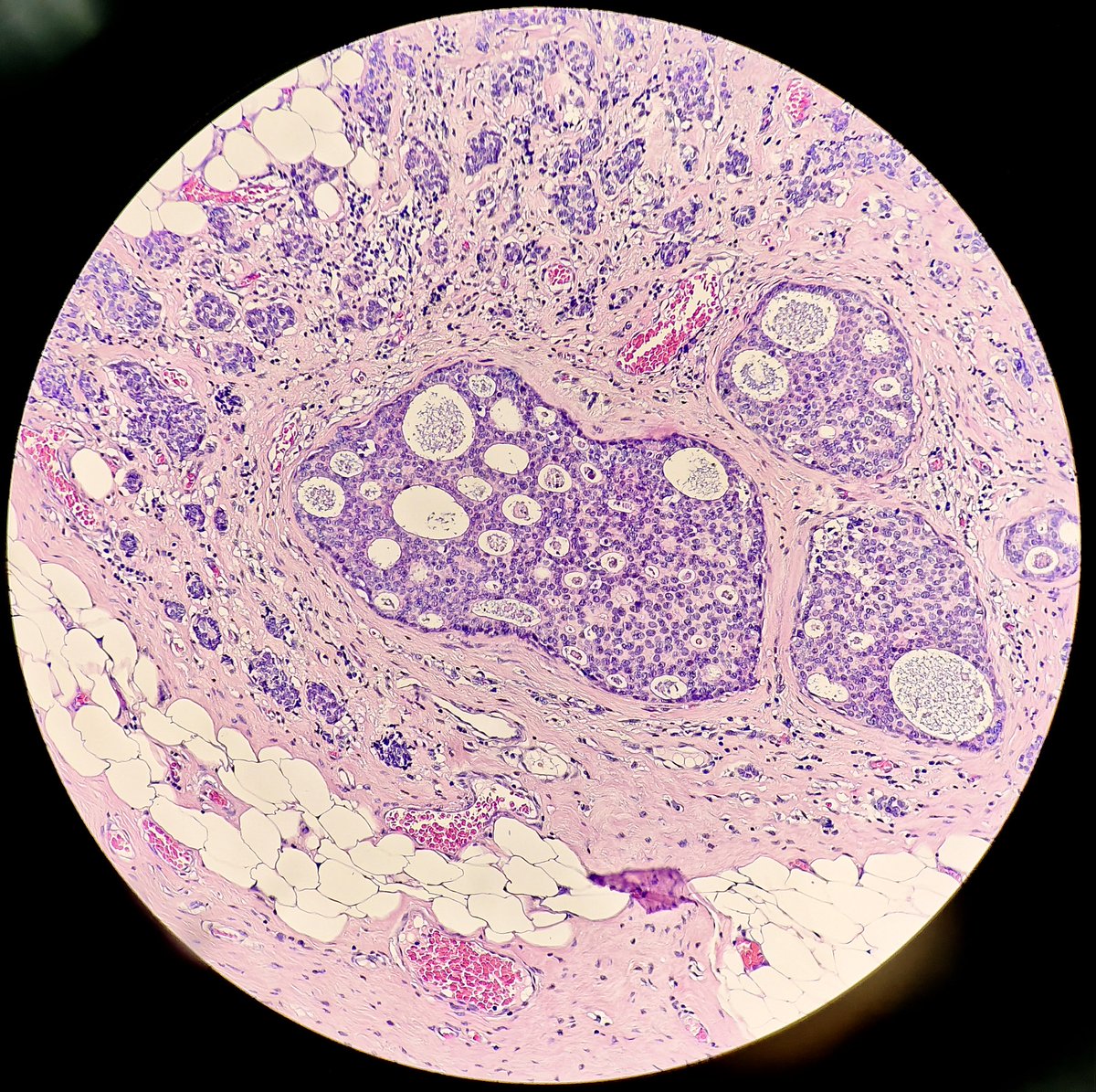!! Extremely rare pitfall : Pseudo DCIS ("DCIS-like") invasive growth pattern seen in an invasive breast carcinoma, NST (invasive ductal carcinoma), grade 2. 
* last pic shows associated low-grade cribriform DCIS for comparison
** bonus in comments

#breastpath #PathX