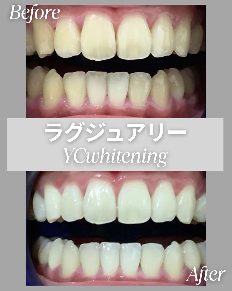 YCwhitening's tweet photo. ＼ホワイトニング無料体験キャンペーン実施中／

🎁憧れの白い歯をあなたに！ホワイトニング体験プレゼント

抽選で3️⃣名様
🌟luxury whitening(1回19,800円)��無料に❗️

【応募方法】
①フォロー
②このポストをいいね&amp;リポスト

【締め切り】
8月31日(日)  

⬇️HP
https://t.co/nNRN14iCFk
 #懸賞 https://t.co/3OuAhcxsQB