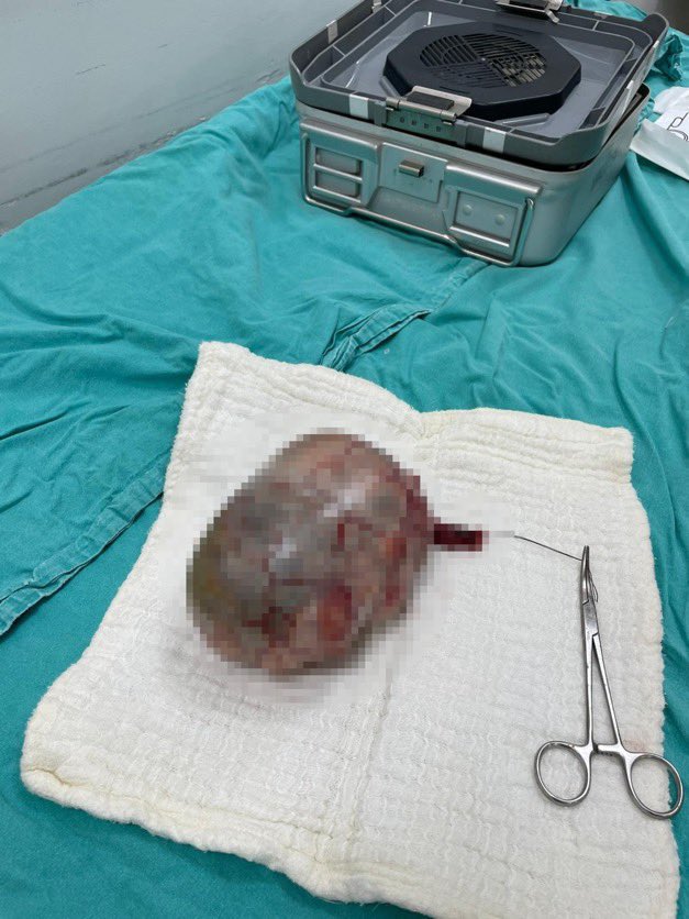 Kahramanmaraş'ta idrar şikayetiyle başvuran bir hastanın testisinde 20 santimetrelik tümör çıktı.