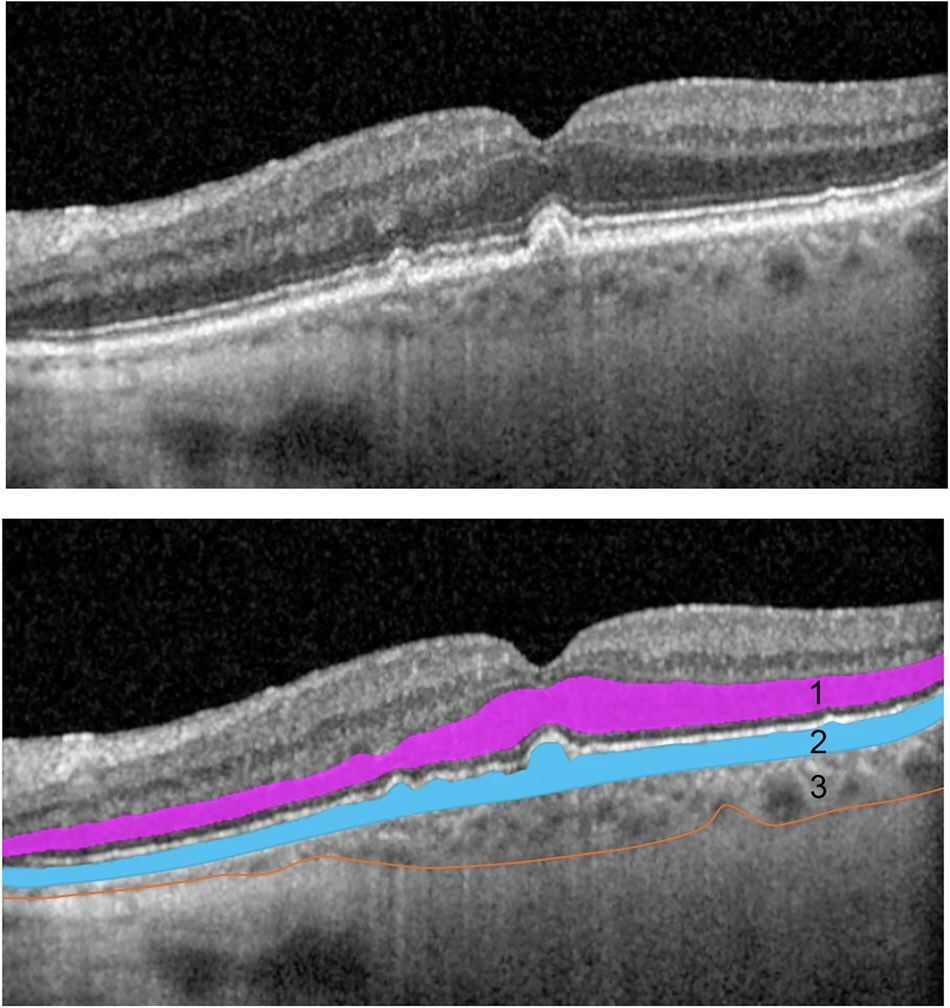 Eye_Journal's tweet image. Even in early/intermediate AMD, structural retinal changes on OCT are linked to reduced visual function under bright & low light. These findings highlight key imaging markers of functional decline before advanced disease.
#Ophthalmology #OpenAccess
nature.com/articles/s4143…
