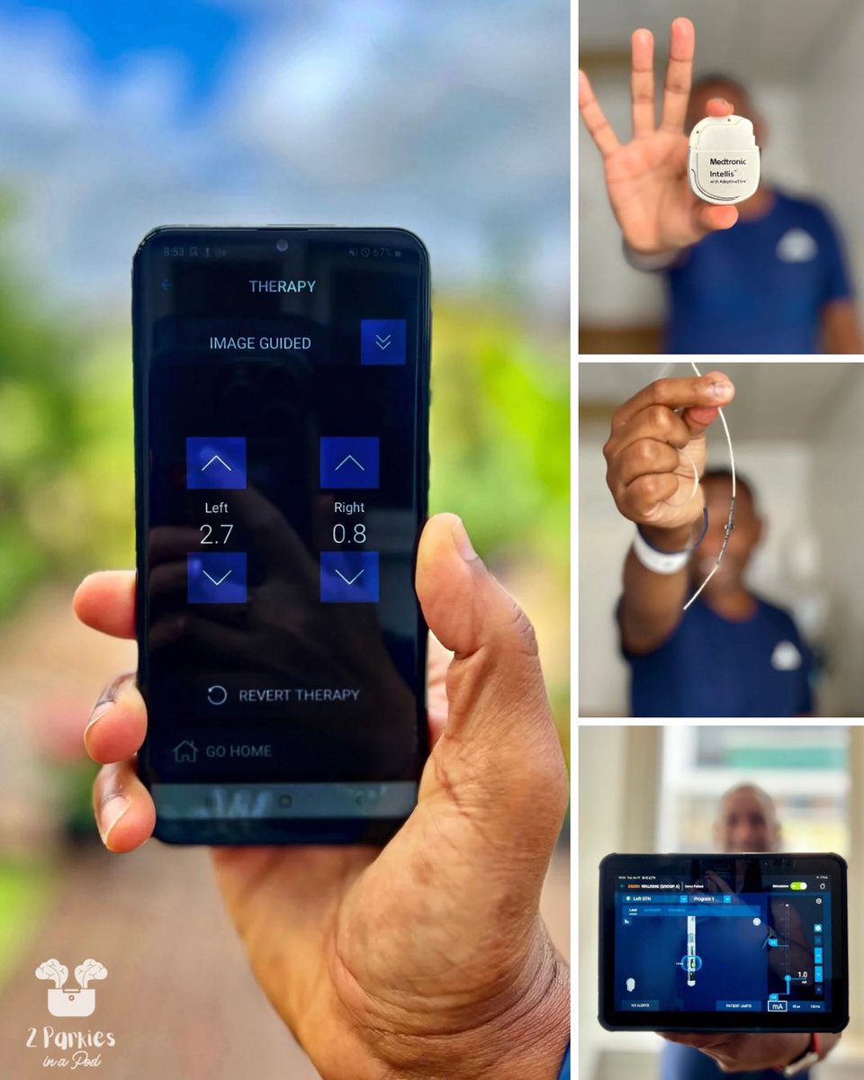morethanatremor's tweet image. Staggered into the neurology hospital last month full of fear, walked out with a skip in my step & renewed hope after 2 tiny computers were implanted in my chest, wired to 4 electrodes in my brain.. all controlled from a phone!🎧👉🏼’DBS Diaries’ 2parkiesinapod.com #parkinsons