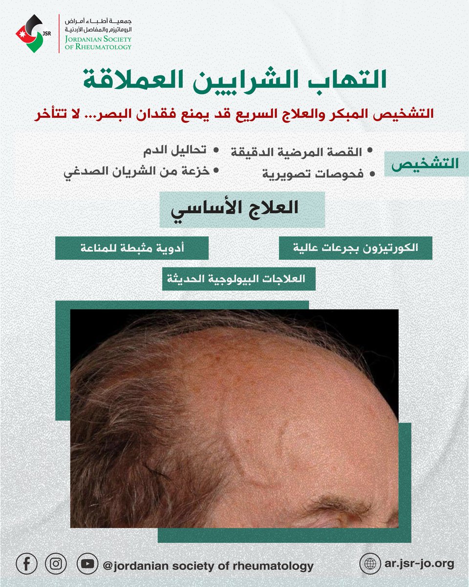 Jordanian Society of Rheumatology - JSR (@jsrheumatology) on Twitter photo التشخيص المبكر والعلاج السريع قد يمنع فقدان البصر... لا تتأخر📷
اضغط على الرابط التالي للتفاصيل
tinyurl.com/2tp6v87b
#مرضى_الروماتزم #مرضى_الروماتيزم #جمعية_أطباء_الروماتيزم_الأردنية
#التهاب_الشرايين #GCA #الرعاية_الطبية #أمراض_الروماتيزم التشخيص المبكر والعلاج السريع قد يمنع فقدان البصر... لا تتأخر📷
اضغط على الرابط التالي للتفاصيل
tinyurl.com/2tp6v87b
#مرضى_الروماتزم #مرضى_الروماتيزم #جمعية_أطباء_الروماتيزم_الأردنية
#التهاب_الشرايين #GCA #الرعاية_الطبية #أمراض_الروماتيزم