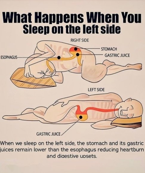 karma_trust_'s tweet image. เมื่อเรานอนตะแคงขวา ตำแหน่งของกระเพาะอาหารจะอยู่สูงกว่าหลอดอาหาร ซึ่งอาจทำให้กรดในกระเพาะสามารถไหลย้อนกลับขึ้นมาได้ง่าย ส่งผลให้เกิดอาการแสบร้อนกลางอกหรือกรดไหลย้อนแต่ถ้าเปลี่ยนมานอนตะแคงซ้าย กระเพาะอาหารจะอยู่ต่ำกว่าหลอดอาหารตามแรงโน้มถ่วง ช่วยป้องกันไม่ให้น้ำย่อยไหลย้อนขึ้นมา