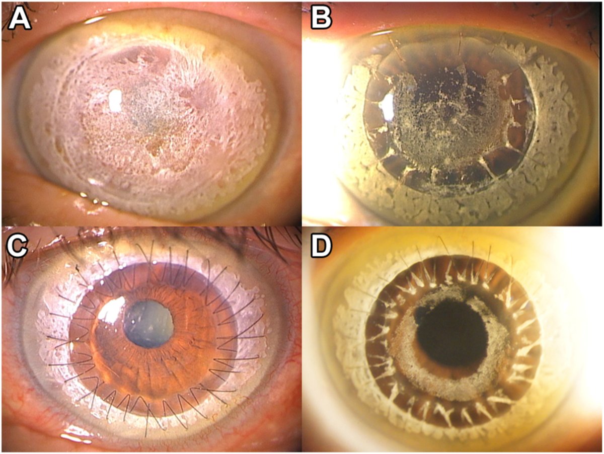 AAOjournal's tweet image. Deliberate Ring Capture of Deposits in Homozygous Granular Corneal Dystrophy
ow.ly/QY1350WcVtN
#ophthalmology