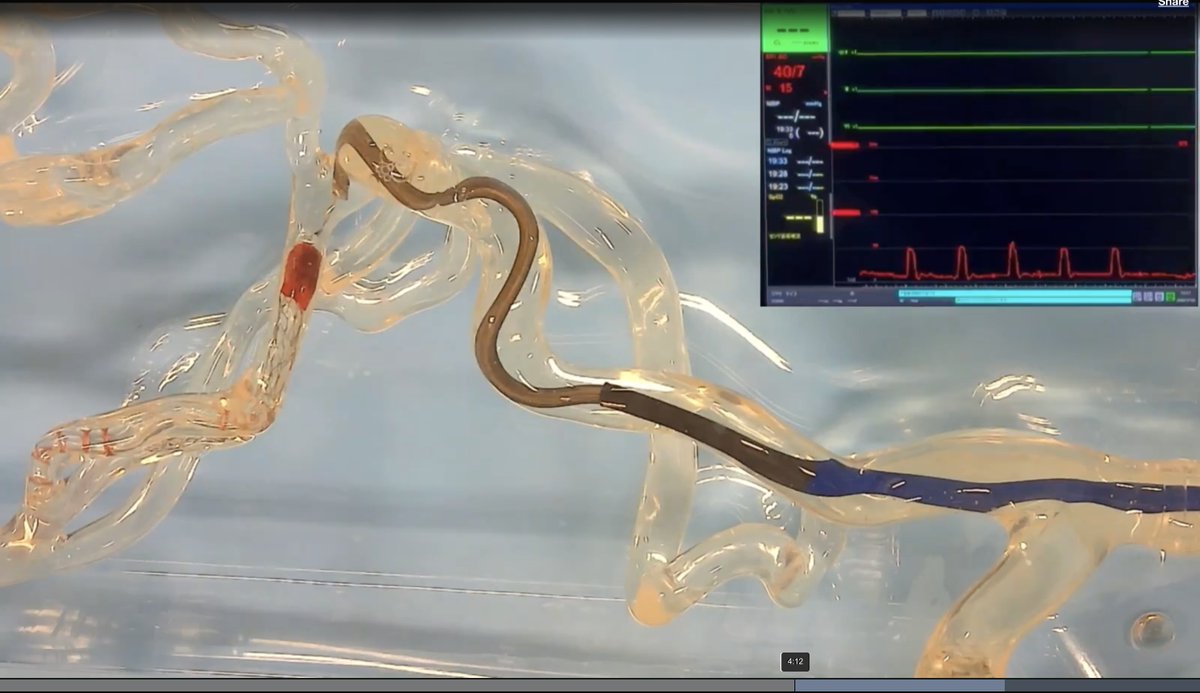 JNIS_BMJ's tweet image. Endovascular thrombectomy is a cornerstone treatment for acute ischemic stroke due to large vessel occlusion. Success depends on securely engaging the clot with the aspiration catheter, but direct visualization of this contact is not possible. This report introduces the novel…