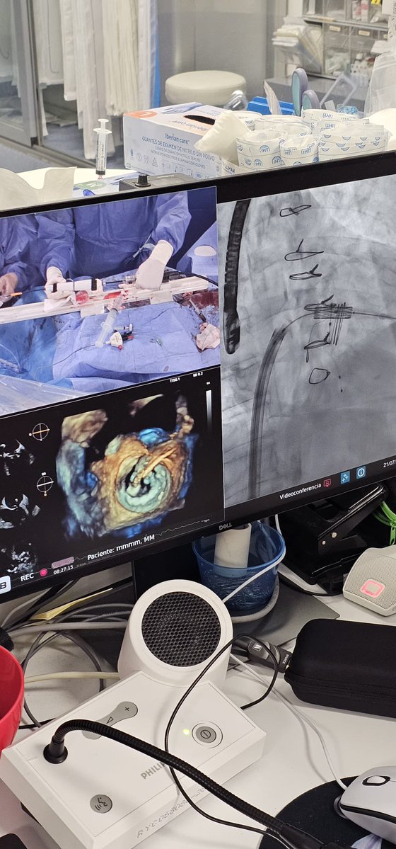 Cardiología Ramón y Cajal (@cardioryc) on Twitter photo Yesterday history was made! First percutaneous mitral valve replacement in 🇪🇸! Succesful procedure thanks to all the team 🙌🏼
//
Ayer se hizo historia. Primera sustitución valvular mitral percutánea en 🇪🇸 Éxito gracias a todo el equipo 🙌🏼
<a href="/RyCImagenCardio/">RyC Imagen Cardio</a> <a href="/Card_IntervRyC/">Interv. Cardiol. H. Ramón y Cajal</a> Yesterday history was made! First percutaneous mitral valve replacement in 🇪🇸! Succesful procedure thanks to all the team 🙌🏼
//
Ayer se hizo historia. Primera sustitución valvular mitral percutánea en 🇪🇸 Éxito gracias a todo el equipo 🙌🏼
<a href="/RyCImagenCardio/">RyC Imagen Cardio</a> <a href="/Card_IntervRyC/">Interv. Cardiol. H. Ramón y Cajal</a>