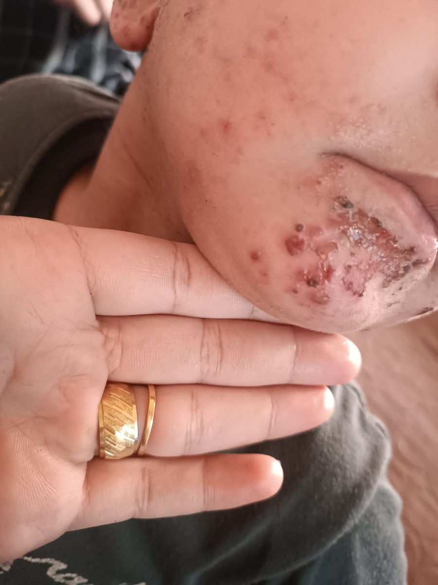 SaharA32452's tweet image. My son, Jude, had a low temperature. I gave him medication from the pharmacy, but it was out of date. A skin disease appeared on his face due to incorrect treatment. Please donate so I can buy proper treatment. Donate and participate chuffed.org/project/129313