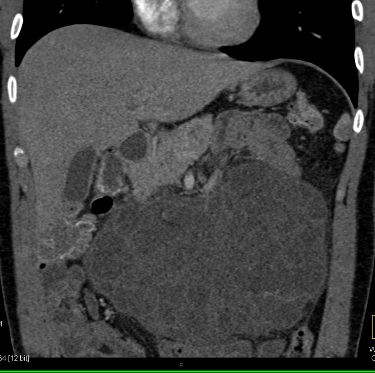 ctisus's tweet photo. The most likely dx?

  A. mesenteric lymphangioma
  B. pancreatic pseudocyst
  C. serous cystadenoma
  D. mucinous cystic neoplasm

Poll below 👇

Answer here: https://t.co/jImFJx27mm https://t.co/GjV8lbsTxO