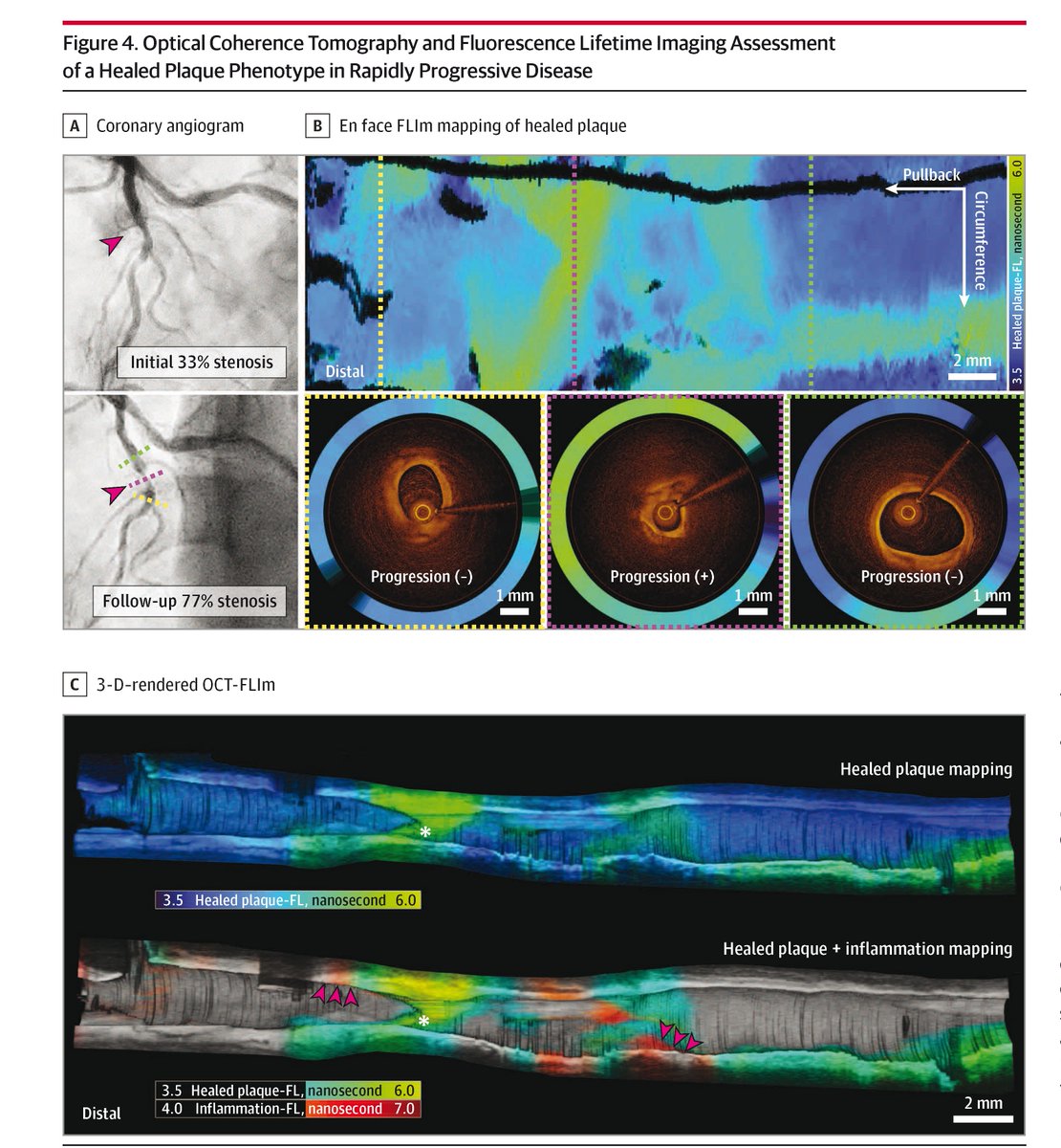 JAMACardio's tweet image. Intravascular optical coherence tomography-fluorescence lifetime imaging is clinically feasible and safe for the comprehensive characterization of coronary plaques. ja.ma/3GgHRwh