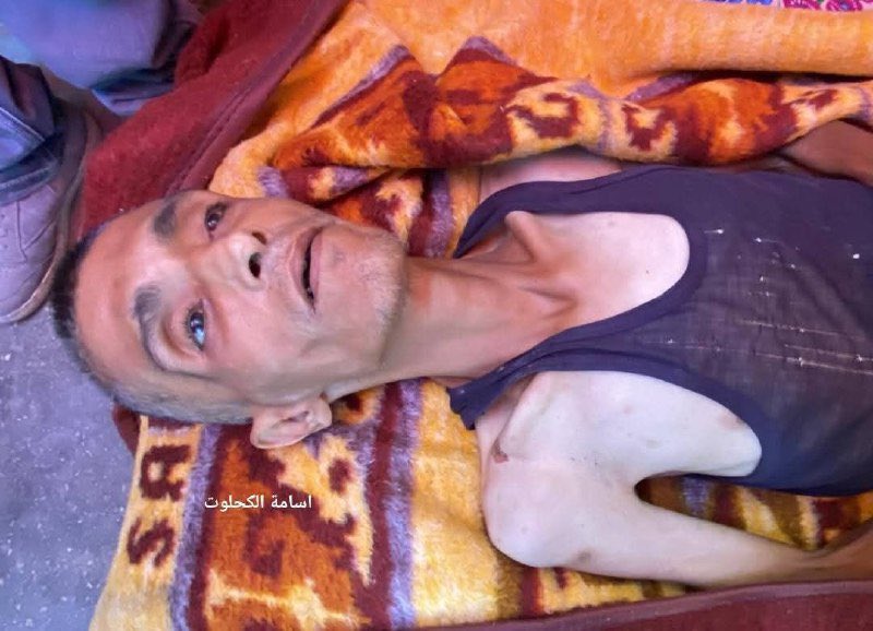 🔴 Gazze’de her yaştan insanı kasıp kavuran bir kıtlık yaşanıyor: Filistinli Ahmed el-Hasanat, açlık nedeniyle şehit oldu.