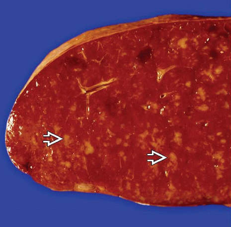 ManelEsteller's tweet image. Update in @biorxivpreprint ! Contributing to characterize resistance to Bruton’s tyrosine kinase #BTK inhibitors in splenic marginal zone #lymphoma #MZL in article led by Dr Francesco Bertoni @frbertoni from the Institute of Oncology Research #Bellinzona #Switzerland…
