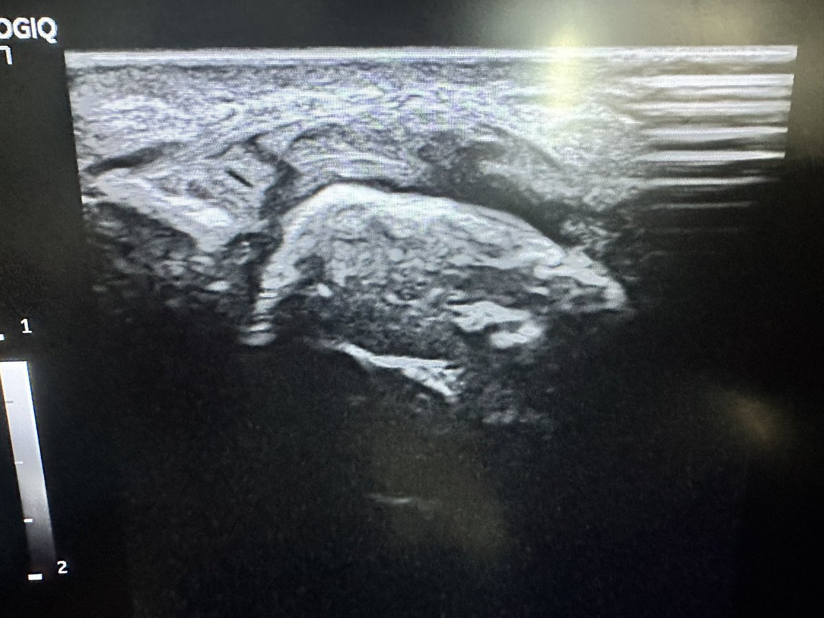 Rishi Navsaria (@rishinavsaria) on Twitter photo Lateral collateral ligament tear of a 1st MTPJ seen in primary care via #POCUS Misdiagnosed as gout. Great case which highlights the benefits of dynamic uss in primary care. Lateral collateral ligament tear of a 1st MTPJ seen in primary care via #POCUS Misdiagnosed as gout. Great case which highlights the benefits of dynamic uss in primary care.