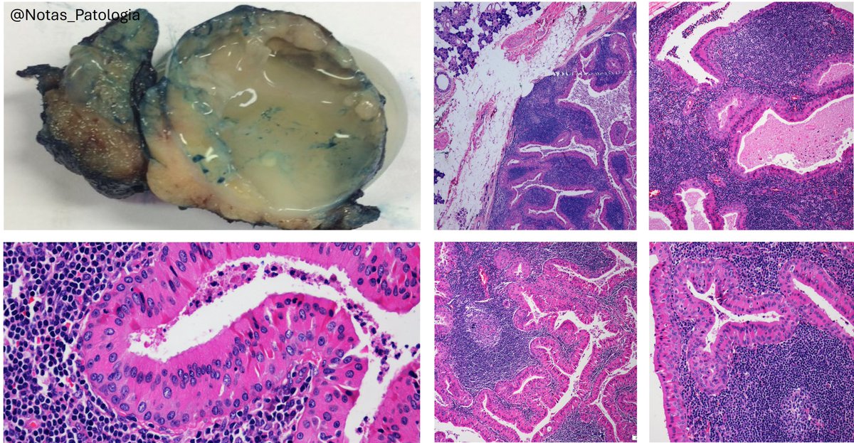 🔬 Warthin tumour

📌 Benign salivary gland tumour characterized by bilayered oncocytic epithelium and lymphoid stroma.

🧾 Definition (WHO 5th ed.)
Benign neoplasm composed of ductal, papillary, and cystic structures lined by bilayered oncocytic epithelium, supported by a