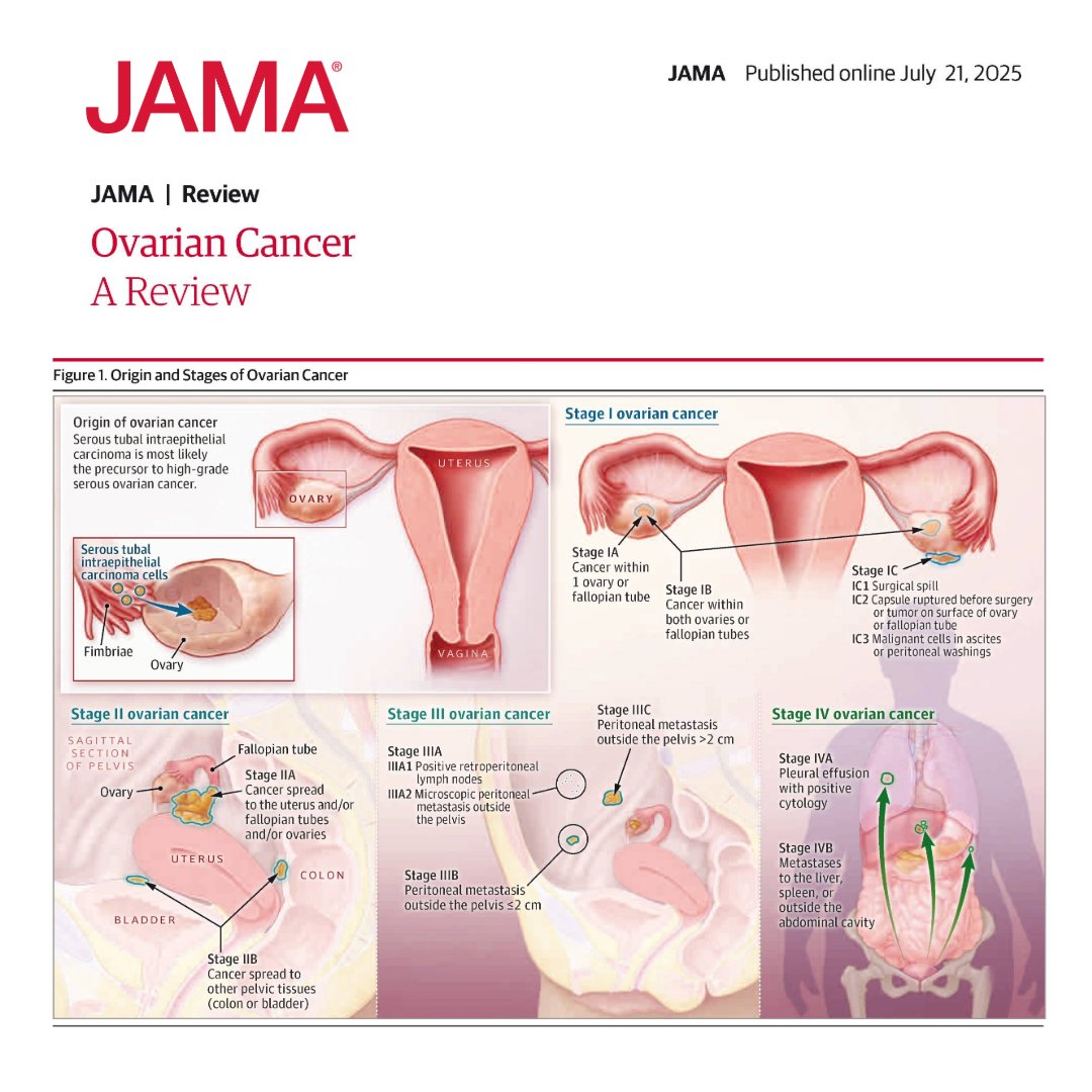 JAMAOnc's tweet image. From @JAMA_current: Approximately 21 000 women are diagnosed with ovarian cancer annually in the US.
This Review summarizes the diagnosis and management of high-grade serous ovarian cancer.
ja.ma/44I2mv9