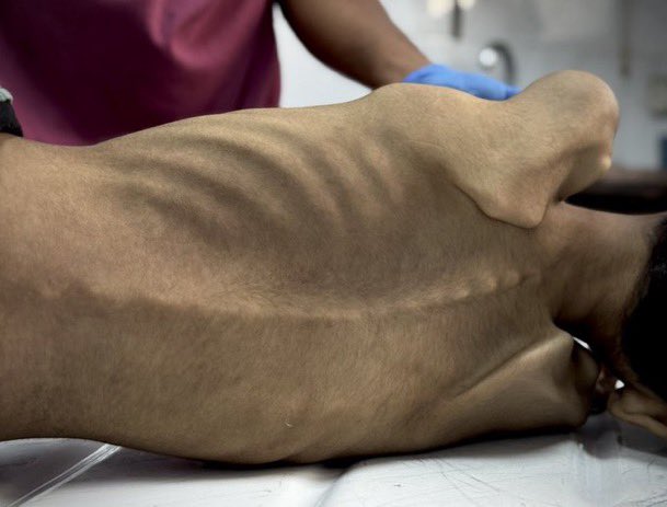 🚨(HASSAS) 

İsrail’in abluka uyguladığı Gazze'de son 24 saatte 4'ü çocuk 15 Filistinli açlıktan hayatını kaybetti.