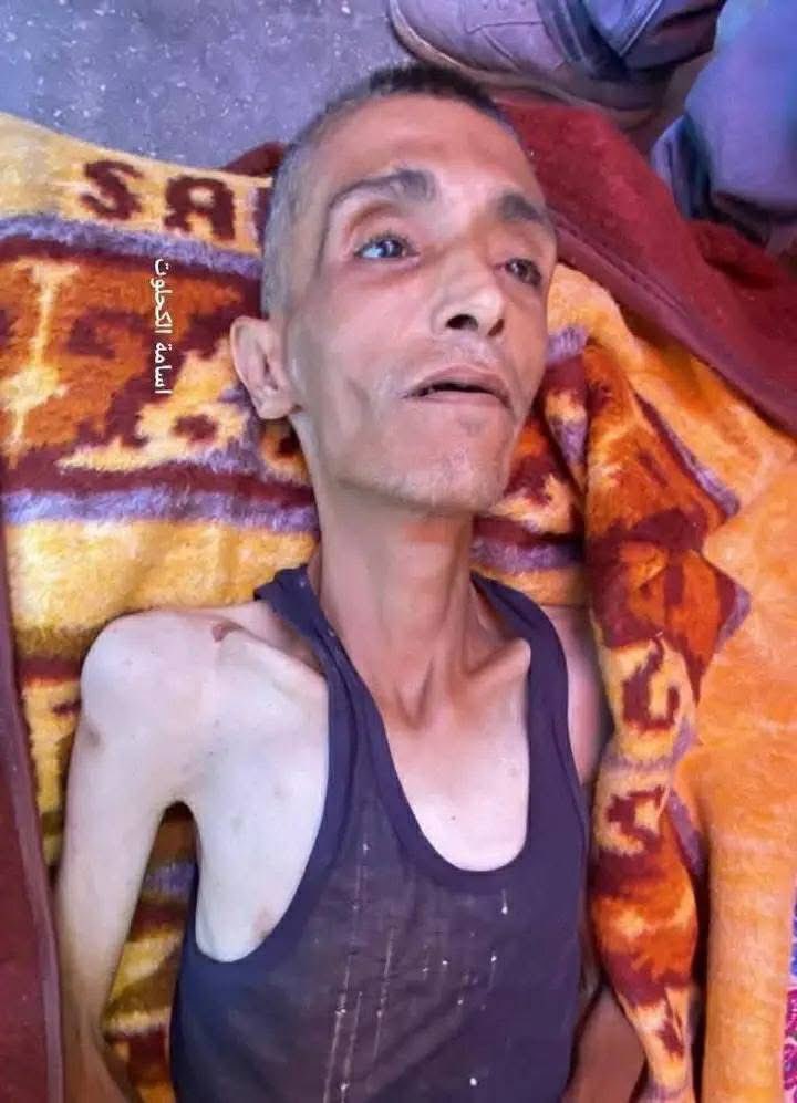 Gaza_Gaza2023's tweet image. Death of Ahmed Al-Hasanat due to malnutrition.
More than fifteen deaths caused by severe hunger have been recorded so far in the Gaza Strip, not to mention the deteriorating health conditions of many children due to the lack of baby formula, in addition to other cases among the…