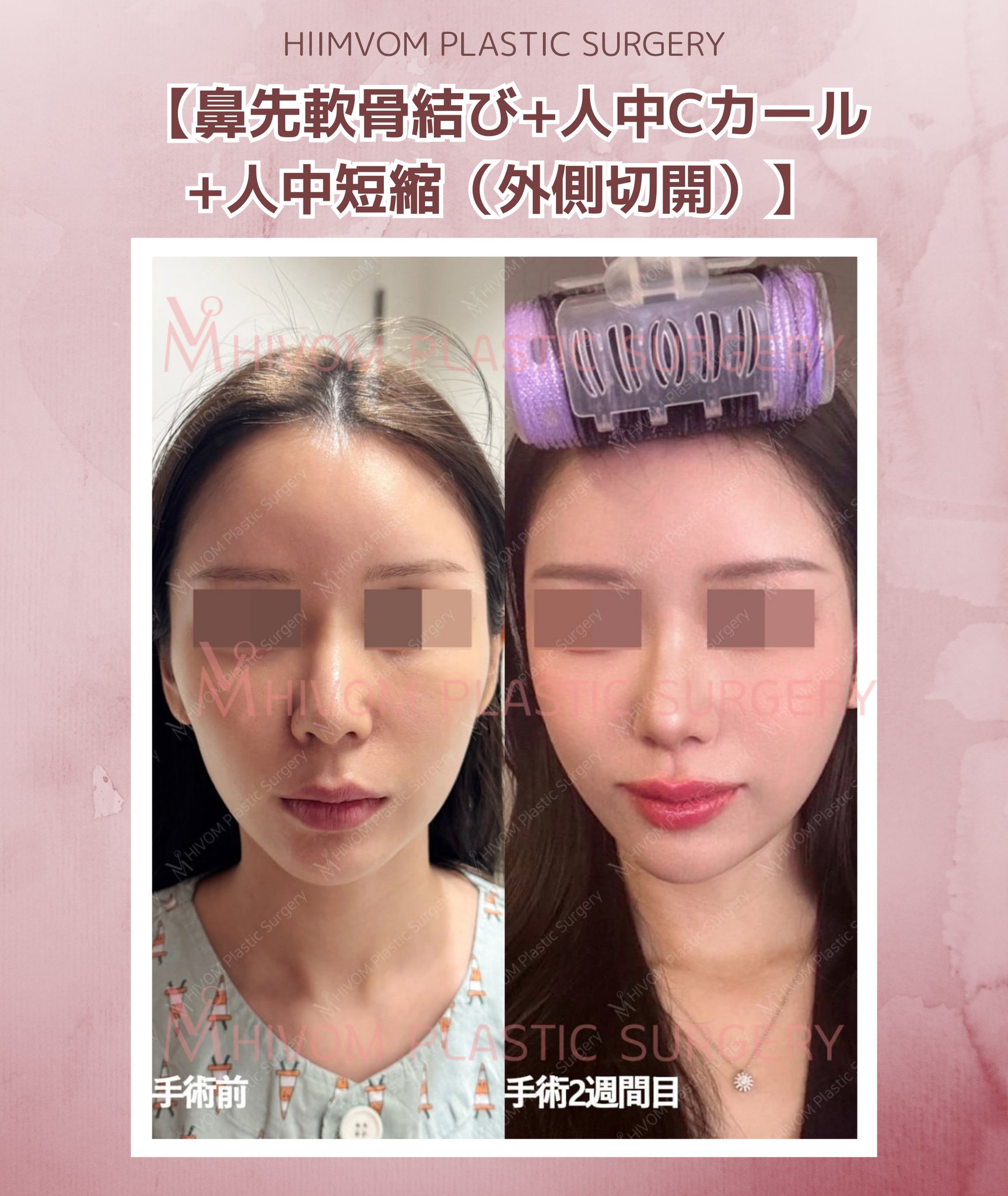 非手術、低侵襲　美容外科 ハイボム美容外科 on X: 