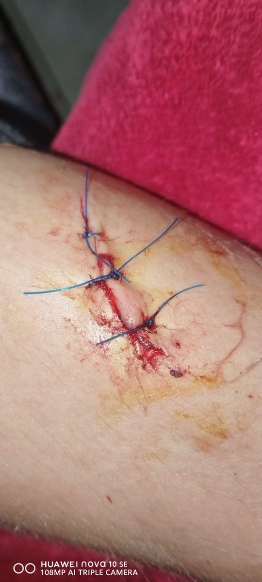 _ArriveAlive's tweet image. Treatment of and Response to Cuts and Bruises
ow.ly/dFbs50ufHMU
#ArriveAlive #Cuts #Bruises
@BurnshieldZA @LevtradeZA @HealthZA