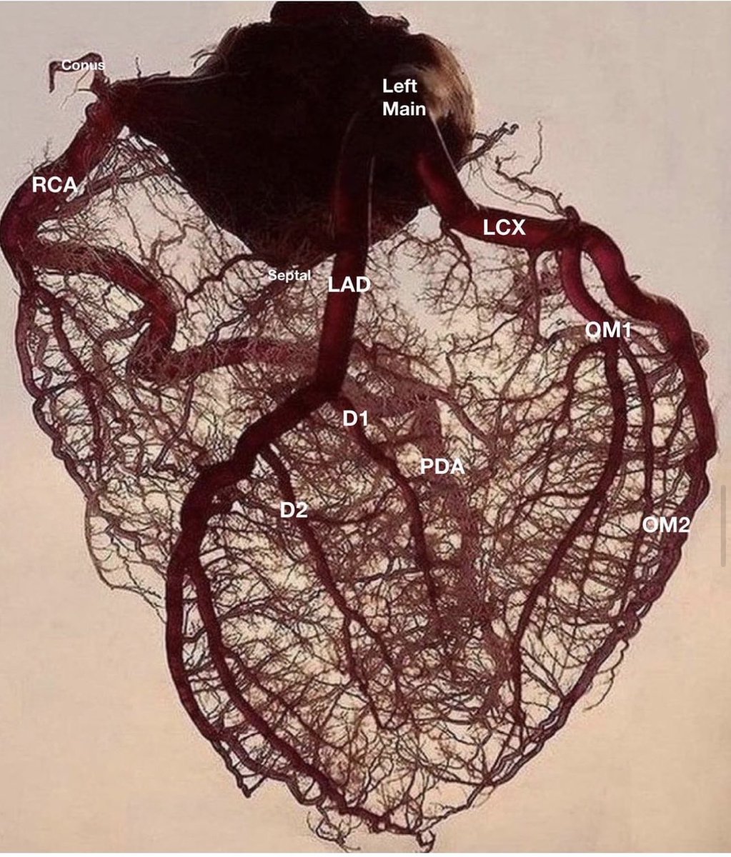 walinjom's tweet image. Coronary Anatomy: 

#MedTwitter 
#Cardiotwitter