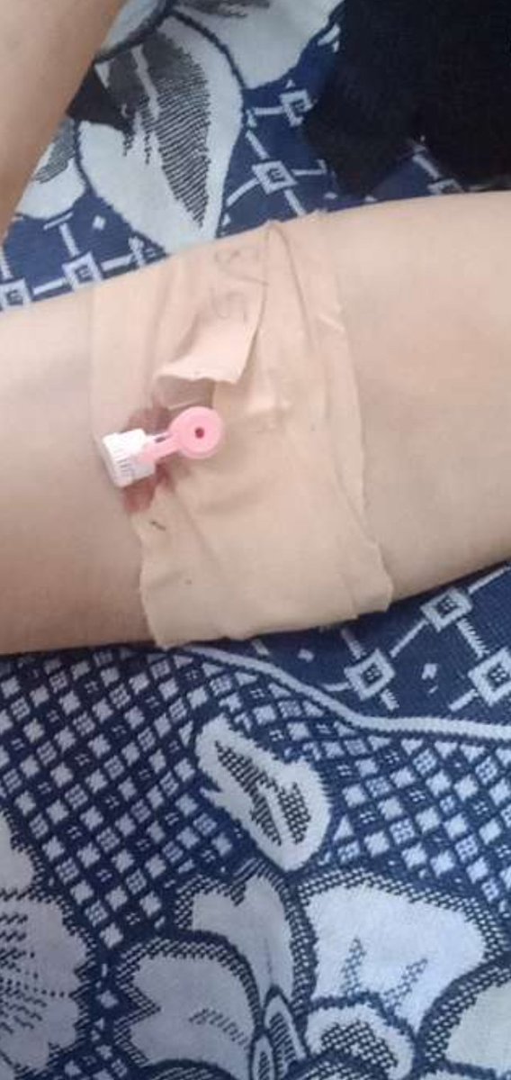 raneenmost16641's tweet image. I went to the hospital again, and my condition is very serious. I’m suffering from high salts, infections, and malnutrition. Please donate to me and support me.
chuffed.org/project/131842…
