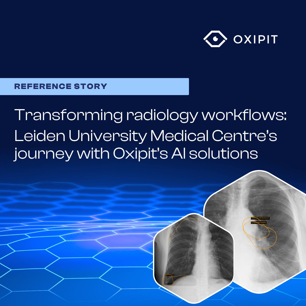 Leiden University Medical Centre is redefining #chestXray workflows with Oxipit’s autonomous #AI.

✅15–20% of studies cleared as normal
✅More time for complex cases
✅Seamless PACS integration
✅Real-world QA impact

Read more: bit.ly/46W0mki

#Radiology #RadTwitter
