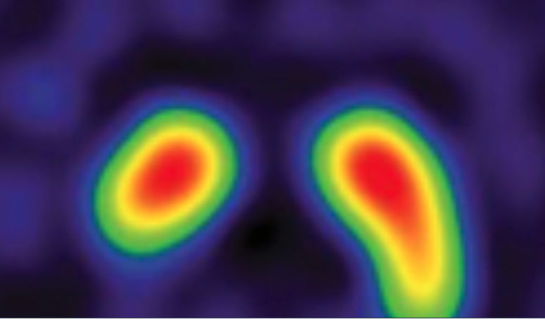 MasudHusain's tweet image. There have been some new developments in understanding #Alzheimer co-pathologies in dementia with Lewy bodies #DLB, considered thoughtfully in an editorial by @rimonaweil in the July issue of @Brain1878
@AlzResearchUK
academic.oup.com/brain/article/…