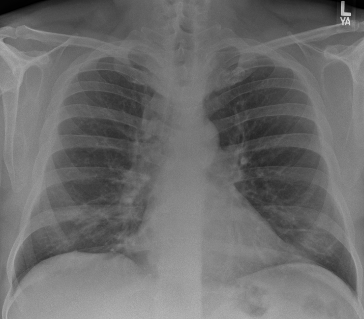 EuroRespSoc's tweet image. Test your knowledge with this week's #radiology image challenge!
Case: 36-year-old male presenting with persistent dry cough
1. What is the main abnormality?
Select your answers: bit.ly/422cxHJ