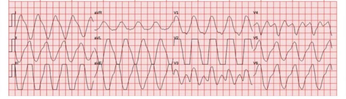 walinjom's tweet image. ECG spot Diagnosis
Case 23
67ys M admitted with sepsis.
1. Diagnosis?
2. Treatment ?
#MedTwitter
#Cardiotwitter
