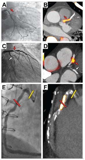Imaging Active Coronary Lesions with PET/CT &amp; CTA

Review of how hybrid imaging identifies high-risk plaques in CAD—combining anatomy and function for better risk stratification.

📖 brnw.ch/21wUkB8
#CardiacImaging #PETCT #Tomography
