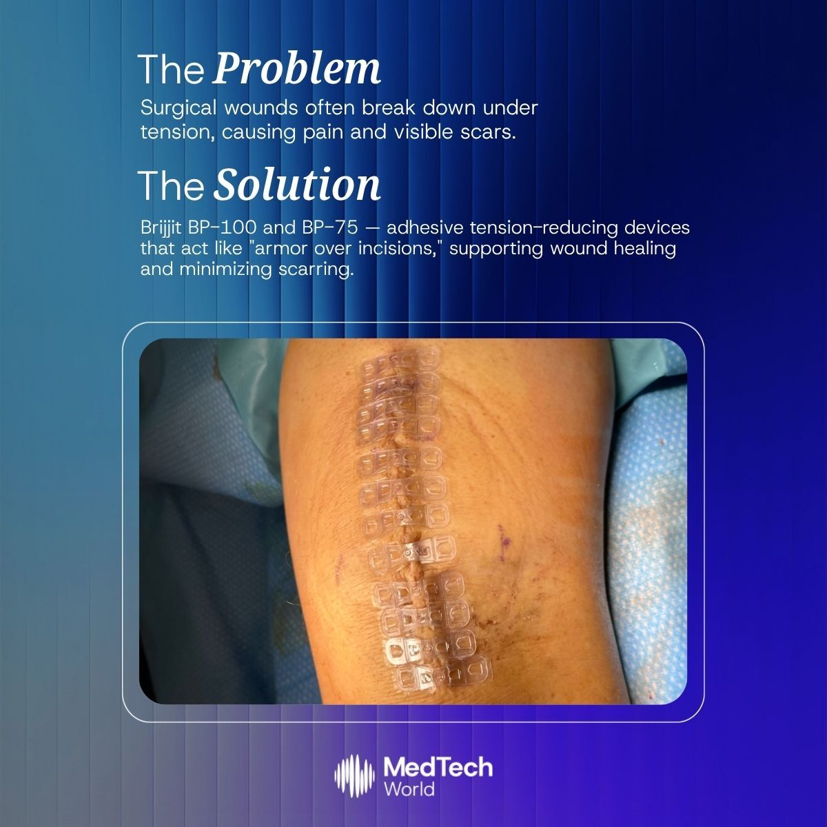 Med_Tech_World's tweet image. We’re spotlighting startups solving real problems.
First up: @BRIJ_medical 🚀
Their Brijjit device supports healing with less scarring.
💡 Want your startup featured or on stage?
Present at our next event:eu1.hubs.ly/H0lWsv30
📍Singapore: Oct 1 | Malta: Nov 12–14