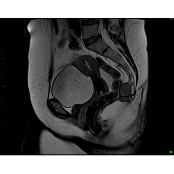 RadiologyACR's tweet image. A 43-year-old woman presents with a complaint of constipation.#ACRCaseinPoint bit.ly/4k9OLRv