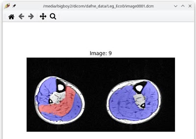 Radiology: Artificial Intelligence (@radiology_ai) on Twitter photo Deep Anatomical Federated Network (Dafne): An Open Client-server Framework for the Continuous, Collaborative Improvement of Deep Learning–based Medical Image Segmentation doi.org/10.1148/ryai.2… <a href="/UniBasel_en/">University of Basel</a> <a href="/unipv/">Università di Pavia</a> #DeepLearning #ML #MachineLearning Deep Anatomical Federated Network (Dafne): An Open Client-server Framework for the Continuous, Collaborative Improvement of Deep Learning–based Medical Image Segmentation doi.org/10.1148/ryai.2… <a href="/UniBasel_en/">University of Basel</a> <a href="/unipv/">Università di Pavia</a> #DeepLearning #ML #MachineLearning