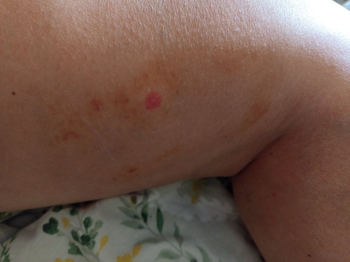 JoaJuan2's tweet image. I am in the shade like a ninja. 🥷😥
My tweets have tragic visibility 😭 so to reverse the situation, an update about my gigantic hematoma.
💉The injection they have given in this place and the ointment really works wonders. 🪄
The hematoma has almost disappeared. 🥳
So a few…