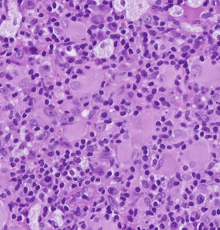 Chest skin lesion, 25 yo young man. Langerin, CD1a, BRAF, ALK and OCT2 are negative in the histiocytes. S100 weakly positive in only part of them. What other stain would you do? Open comments for the answer